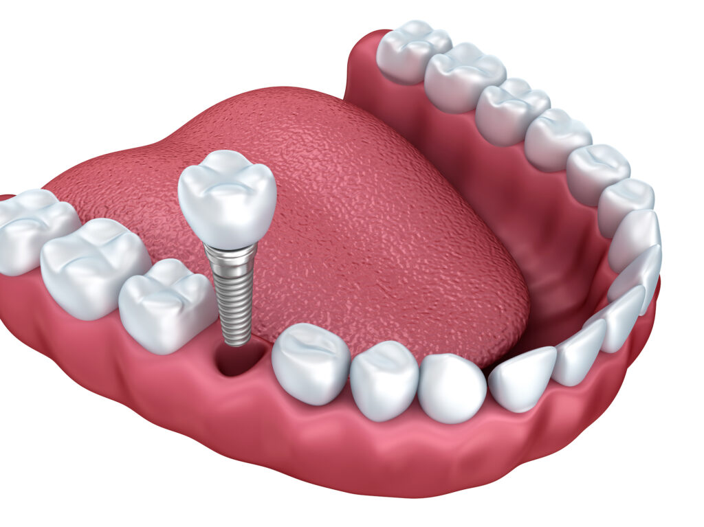 3d lower teeth and dental implant isolated on white